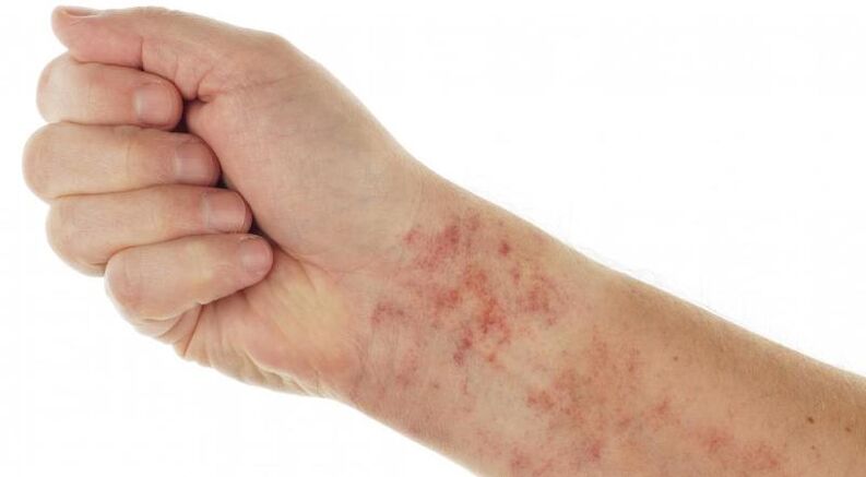 Ízeltlábúak és paraziták okozta bőrbetegségek - Gyógyhírek - Antihisztaminok paraziták